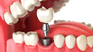 implantes dentales lomas del mirador